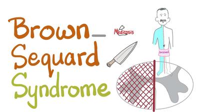 Brown-Sequard综合症 - 脊髓半切断 - 脊髓损伤