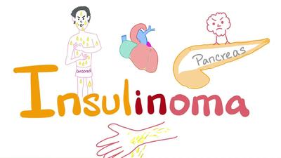 胰岛素瘤