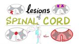 脊髓损伤 - 肌萎缩侧索硬化症（ALS），脊髓灰质炎，脊髓性肌萎缩症，背痛性脊髓炎，前脊动脉闭塞