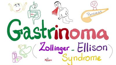 胃泌素瘤（佐林格-艾利森综合症或ZES）